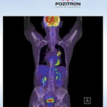 CUM POTI DEPISTA CANCERUL LA TIMP. O noua metoda, inovatoare, si in Romania. PET SCAN – Positron Emission Tomography, in Oradea si la Bucuresti